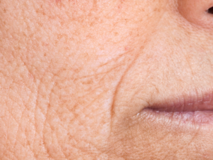 Read more about the article How to Reduce Wrinkles Naturally: A Skin Specialist’s Guide