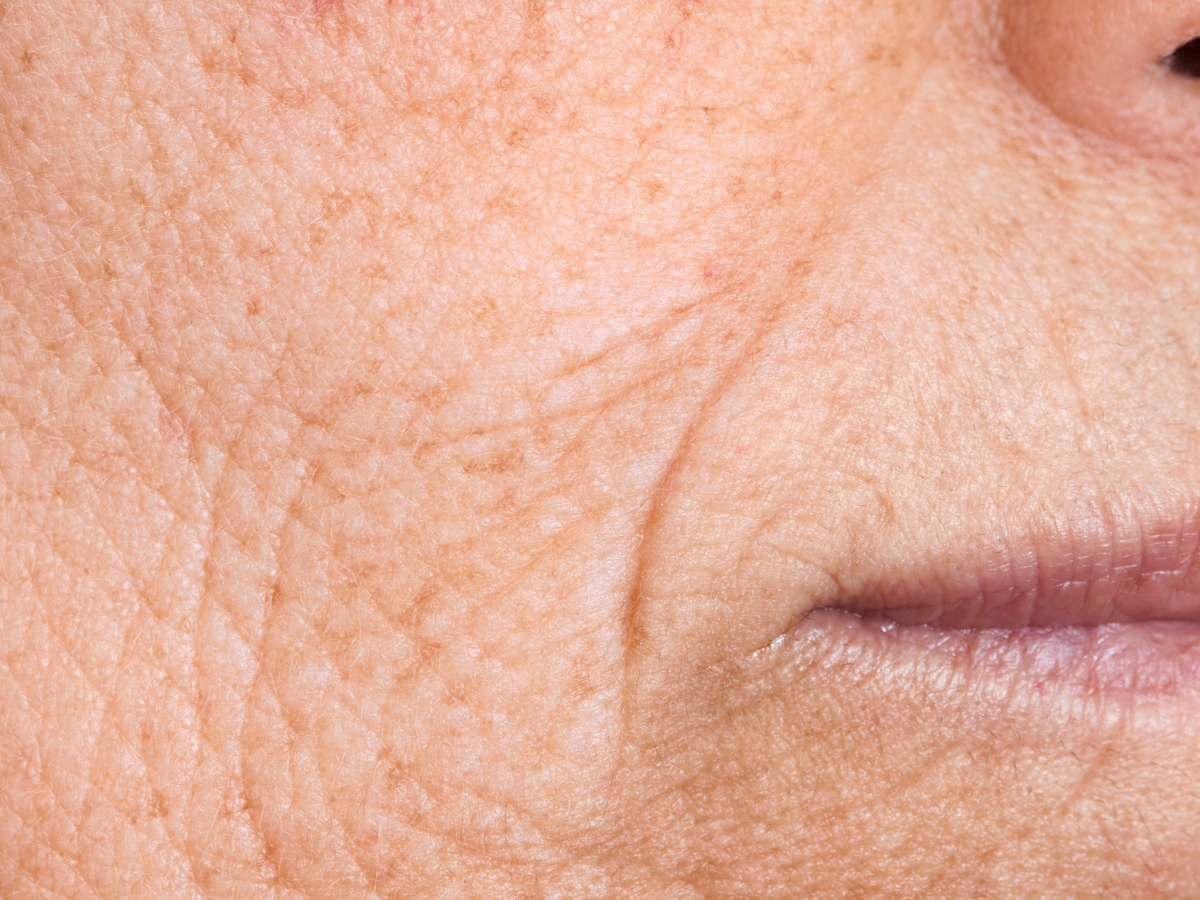 How to Reduce Wrinkles Naturally