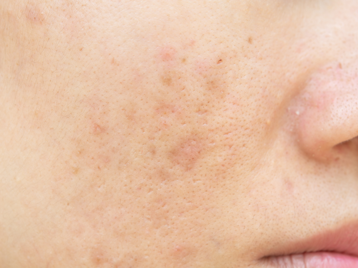 Say Goodbye to Age Spots